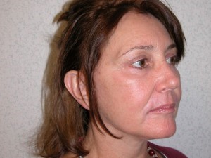 Woman after facelift.